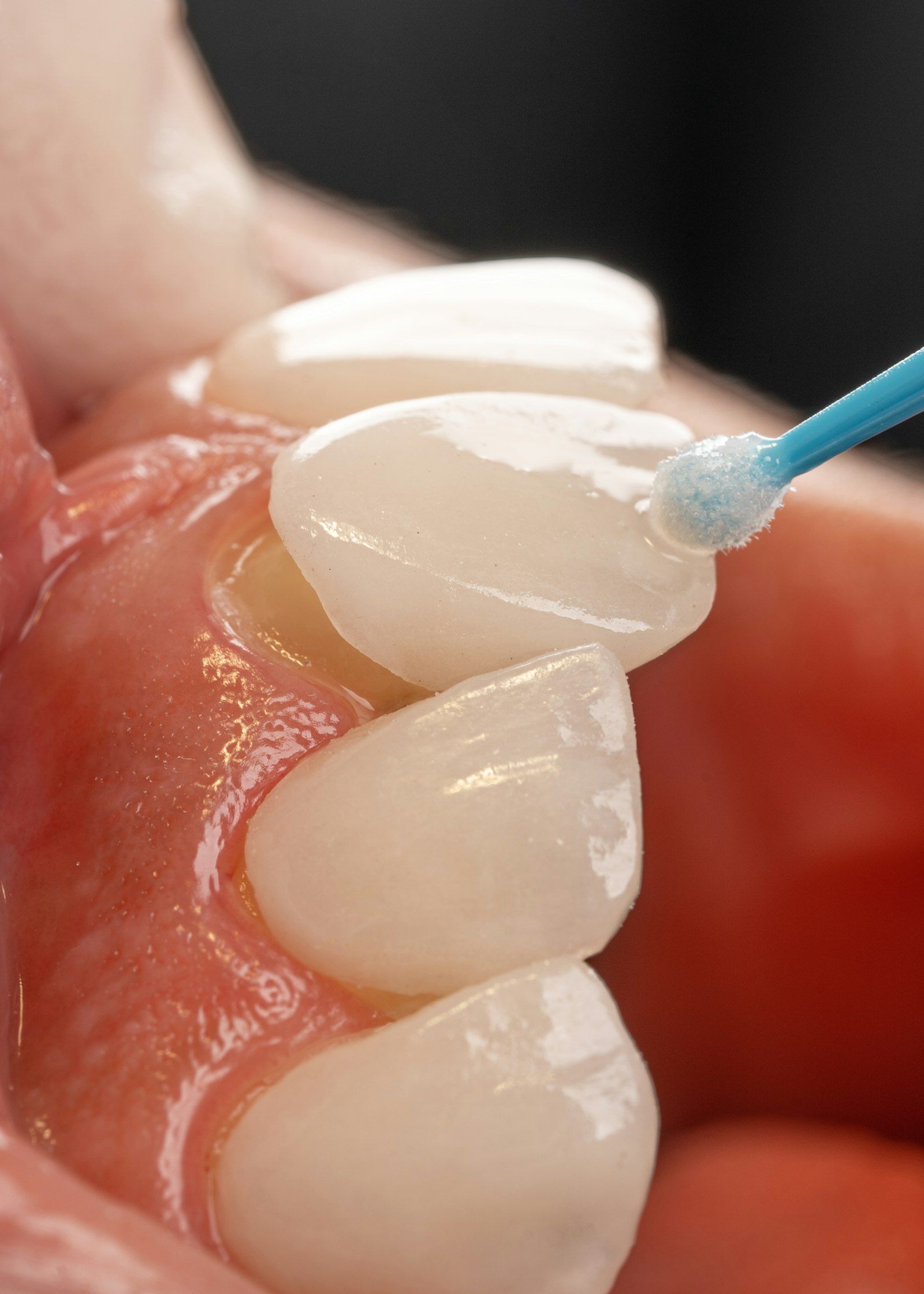 Carilla de cerámica colocada sobre un modelo dental con un aplicador.