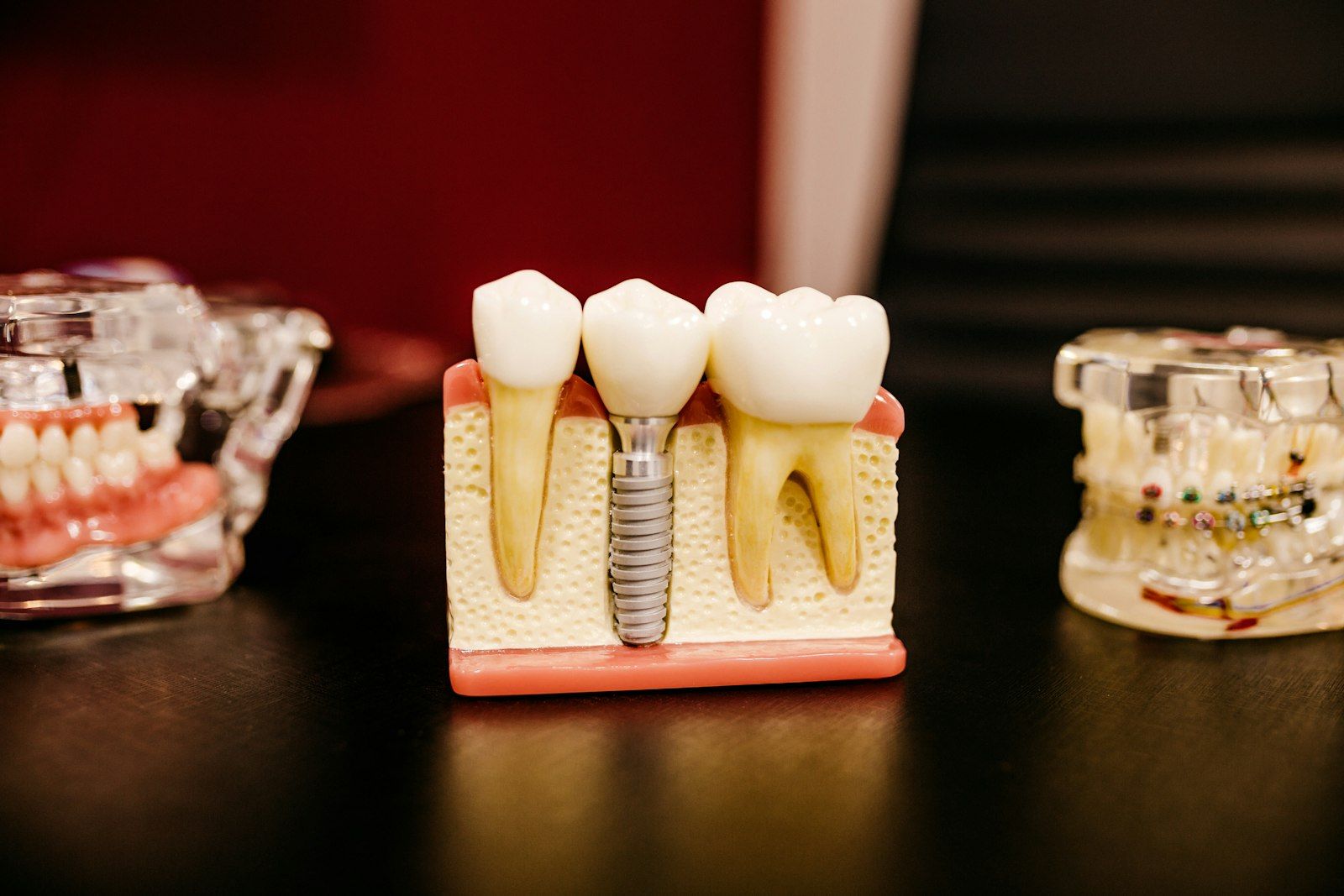 Modelo didáctico con un implante dental entre dos dientes naturales.
