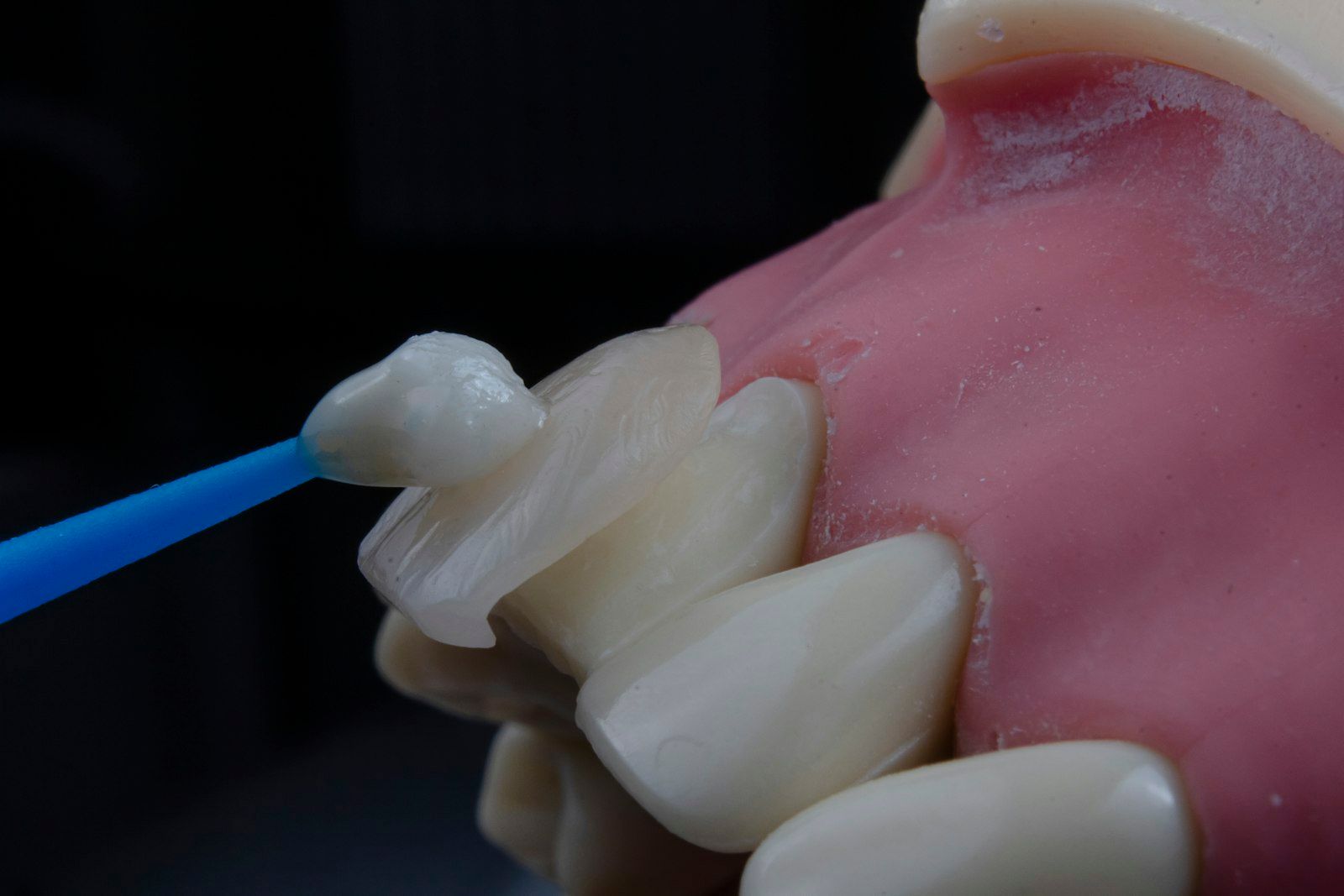 Aplicador sostiene una carilla de cerámica junto a los dientes de un modelo.