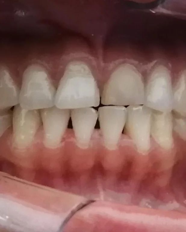 Vista intraoral de frente con los dientes en mordida cruzada, antes de las carillas