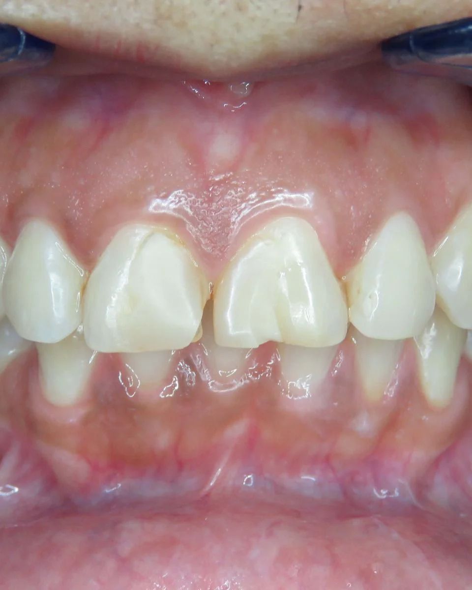 Vista intraoral de frente con un incisivo superior fracturado y los dientes inferiores apiñados