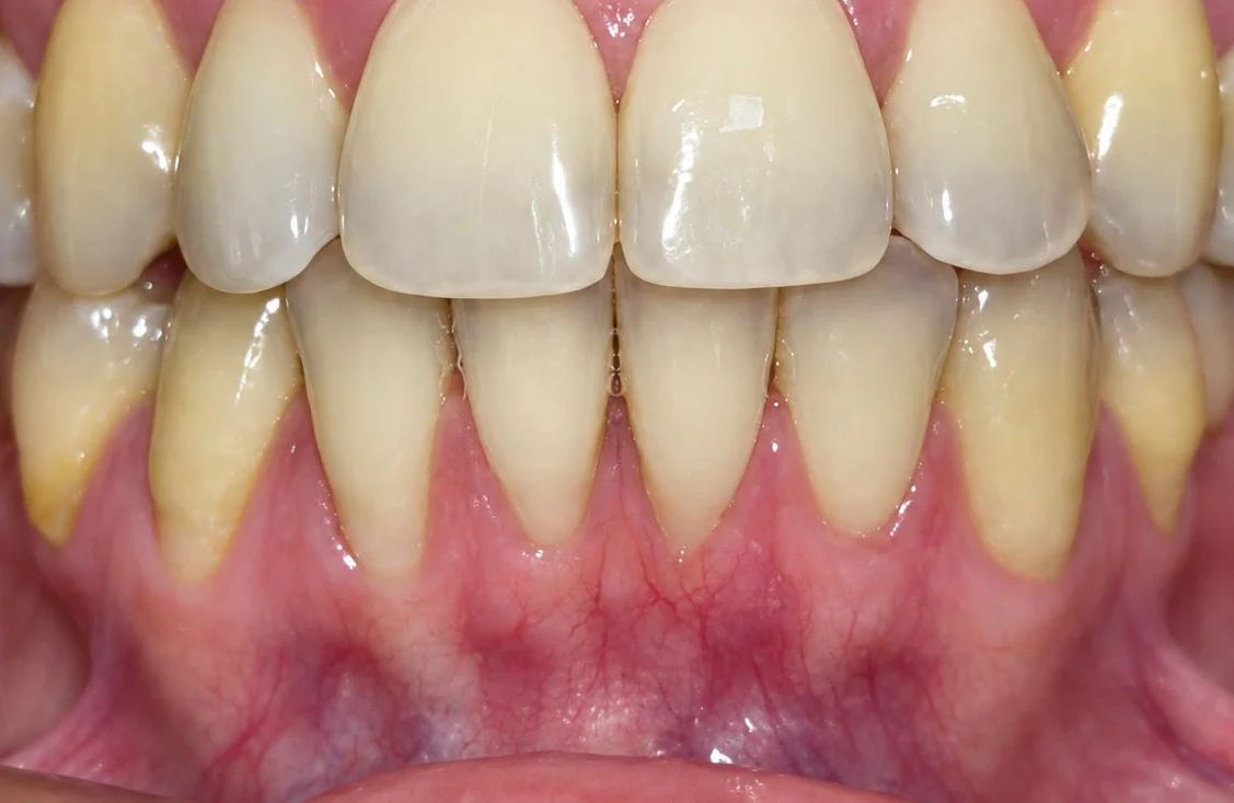 Los dientes anteriores inferiores antes del injerto de tejido conectivo, vistos de frente con la boca en mordida