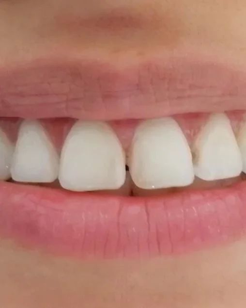 Sonrisa de cerca con un espacio entre los incisivos superiores y los dientes con distinta inclinación