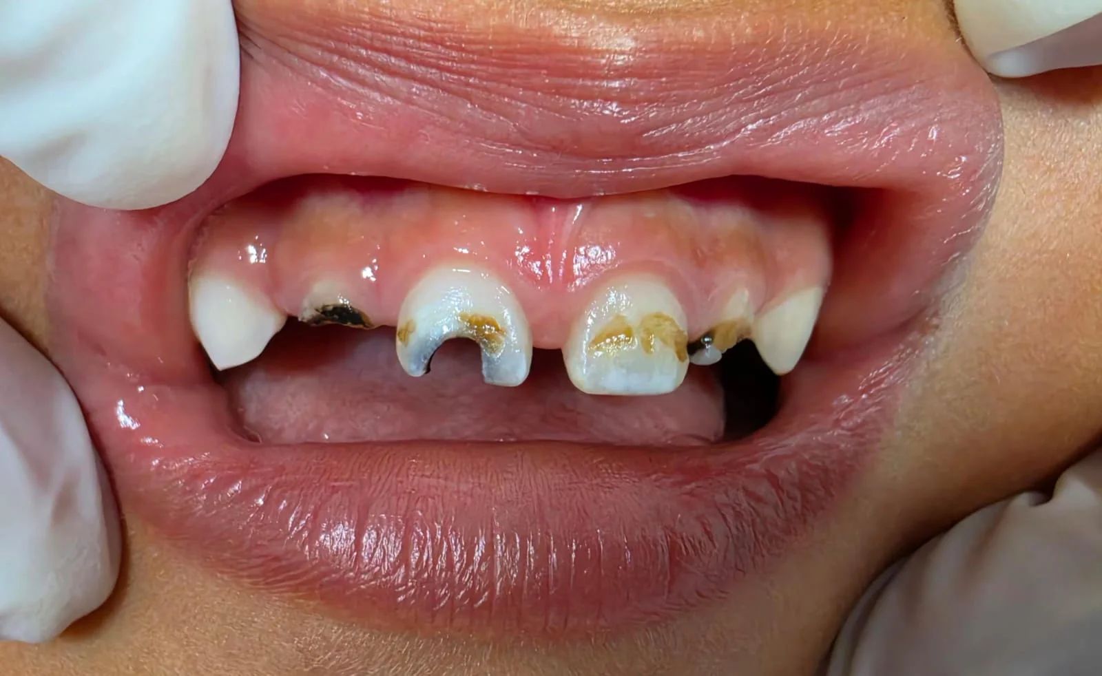 Incisivos superiores de leche con caries extensas, manchas oscuras y uno de ellos con la corona destruida
