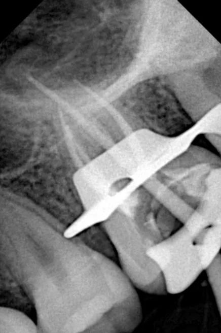 Radiografía del mismo molar aislado con grapa, con los conos de prueba dentro de los conductos