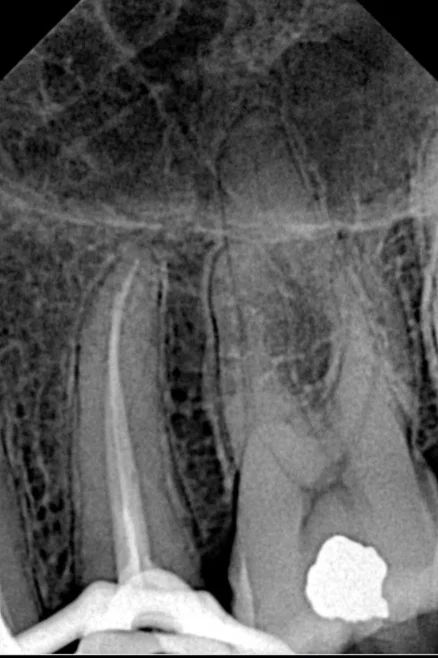 Radiografía del mismo premolar aislado con grapa, con los conos de prueba dentro de los conductos