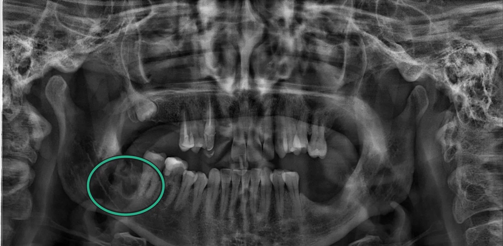 Radiografía panorámica después de la cirugía, con la zona de la extracción del tercer molar inferior derecho señalada con un círculo