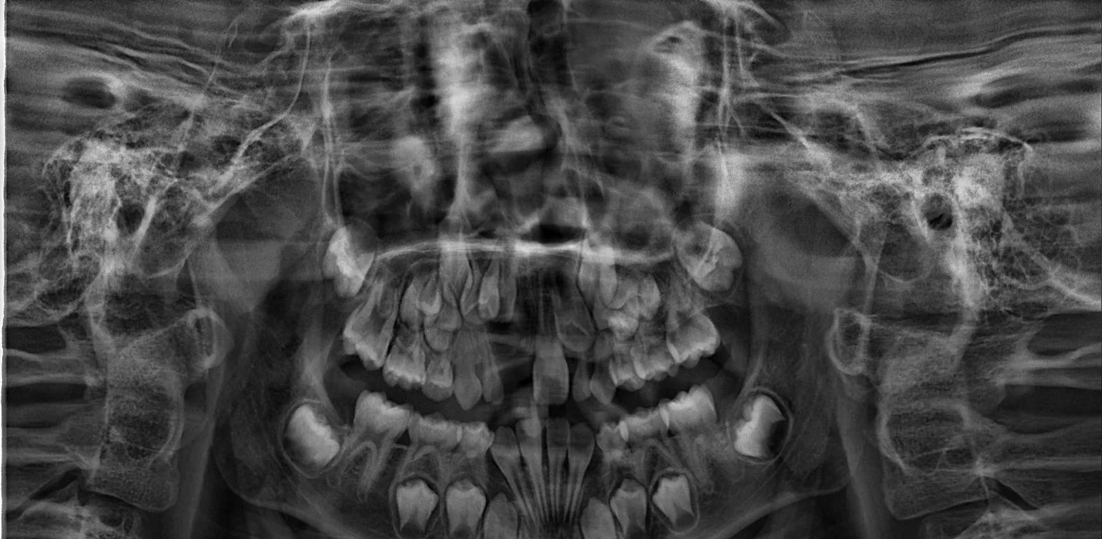 Radiografía panorámica de control después de la cirugía, sin la masa en el sector anterior superior