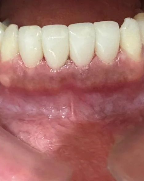 Dientes anteriores inferiores después de las resinas estéticas, vistos de frente con el labio separado