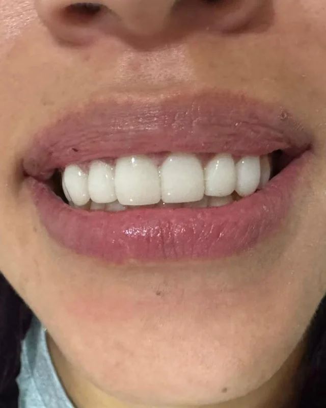 Sonrisa de la paciente después de las resinas estéticas en los dientes superiores
