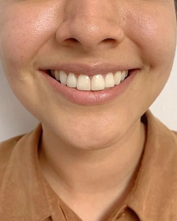 La misma paciente sonriendo después de las resinas, con el espacio cerrado y los incisivos alineados