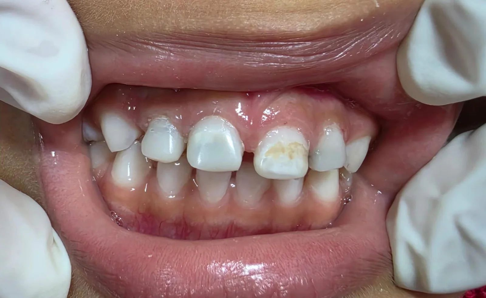Los mismos incisivos de leche con coronas de resina, con la forma de los dientes recuperada