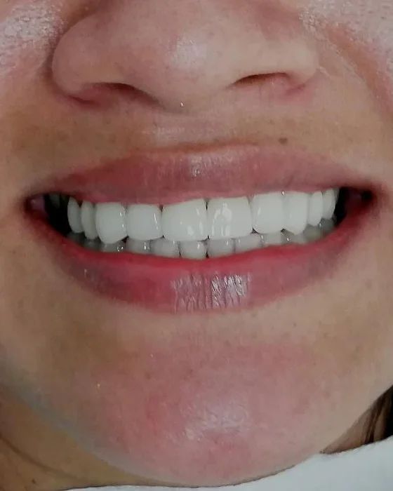 Sonrisa de la paciente después de las carillas, con los dientes superiores de largo y color uniformes