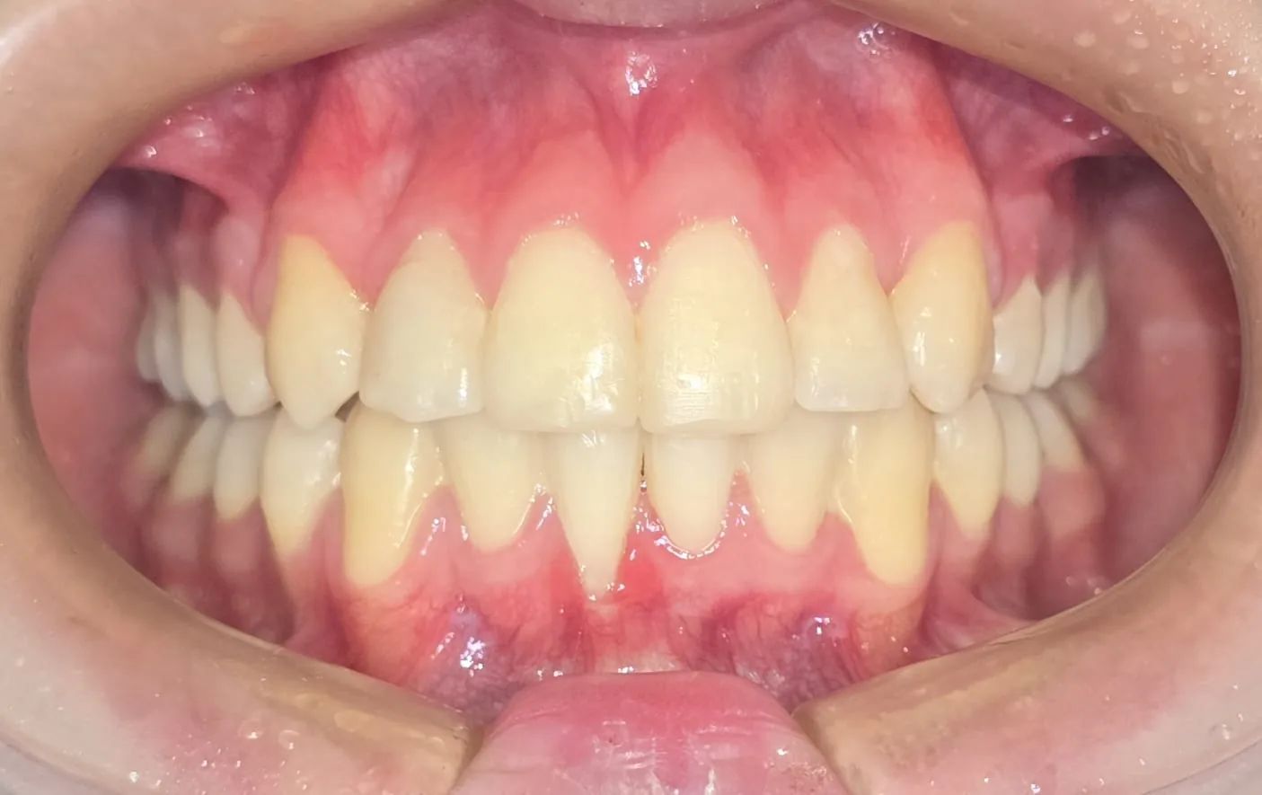 Vista frontal en mordida al final del tratamiento, con los dientes superiores e inferiores alineados