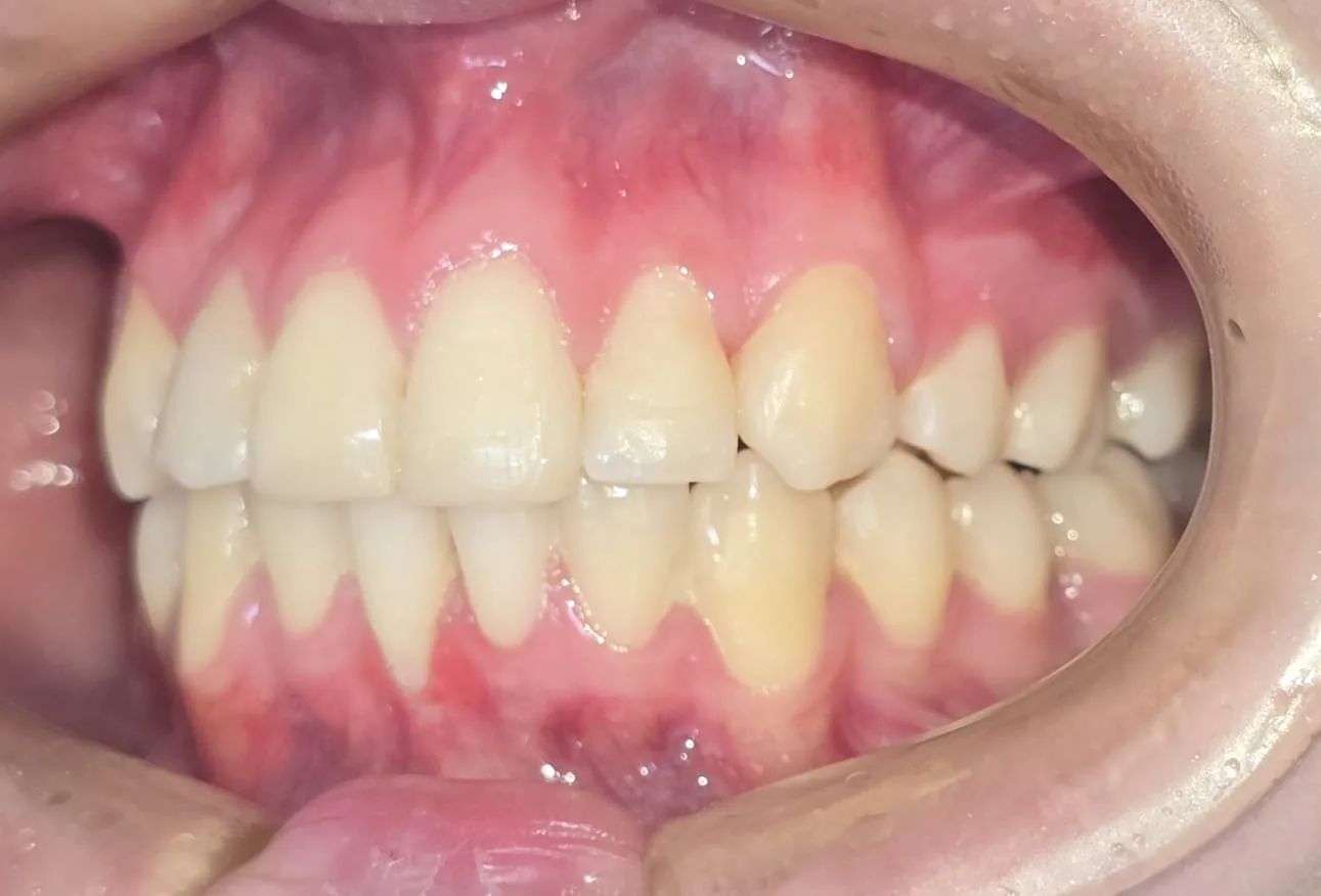 Vista lateral derecha al final, con los dientes superiores e inferiores encajando entre sí
