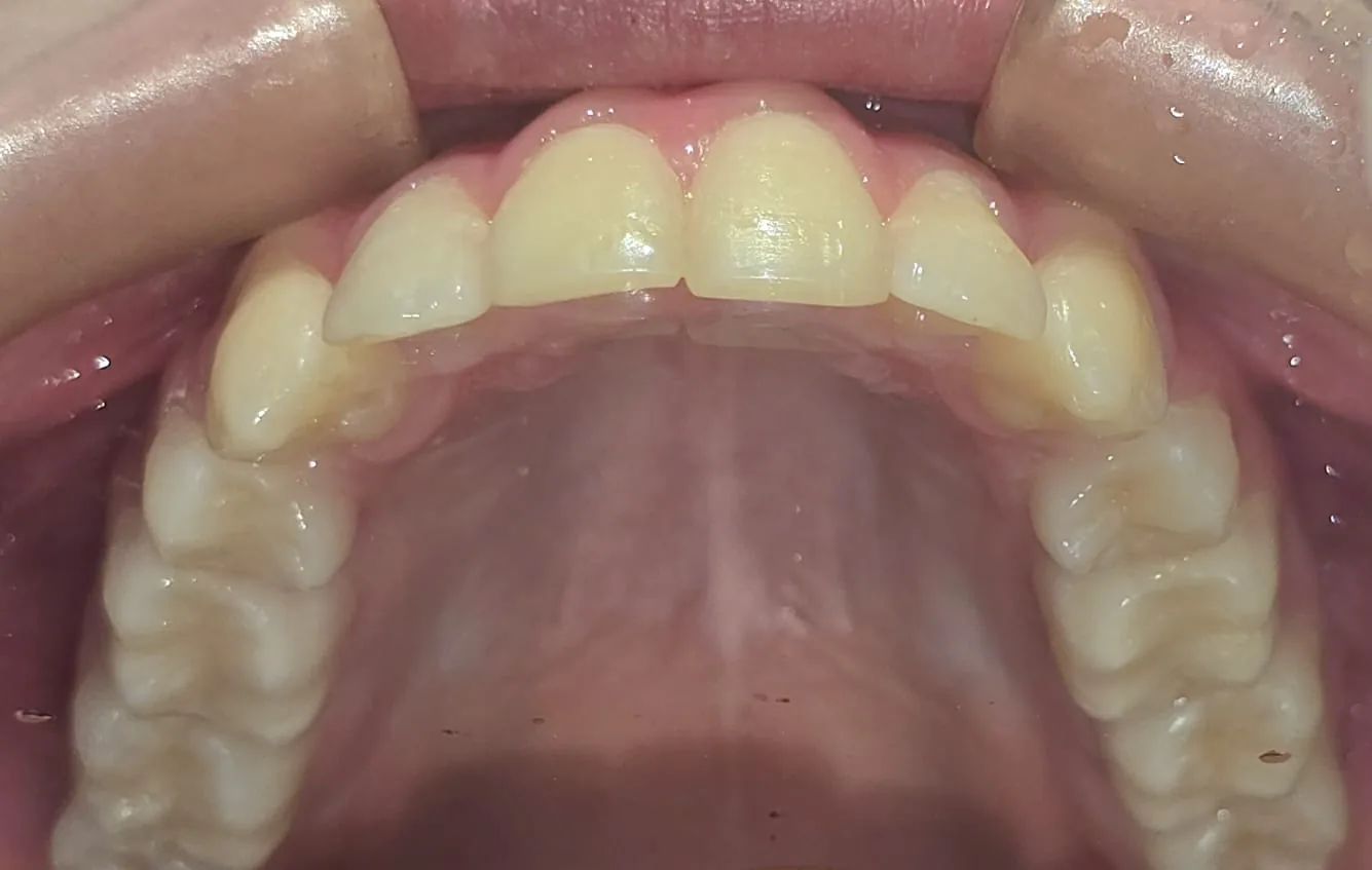 Arcada superior vista desde abajo al final, con los dientes formando una curva continua