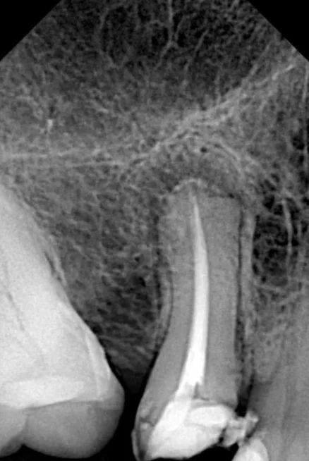 Radiografía final del premolar con el conducto obturado, donde se aprecia la recuperación del absceso periapical