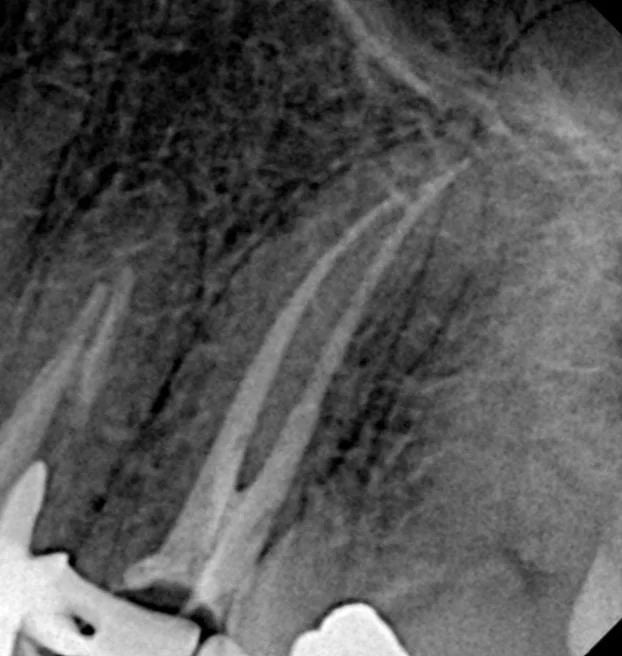 Radiografía de la obturación tomada con otra angulación, donde se ven los dos conductos del premolar rellenos