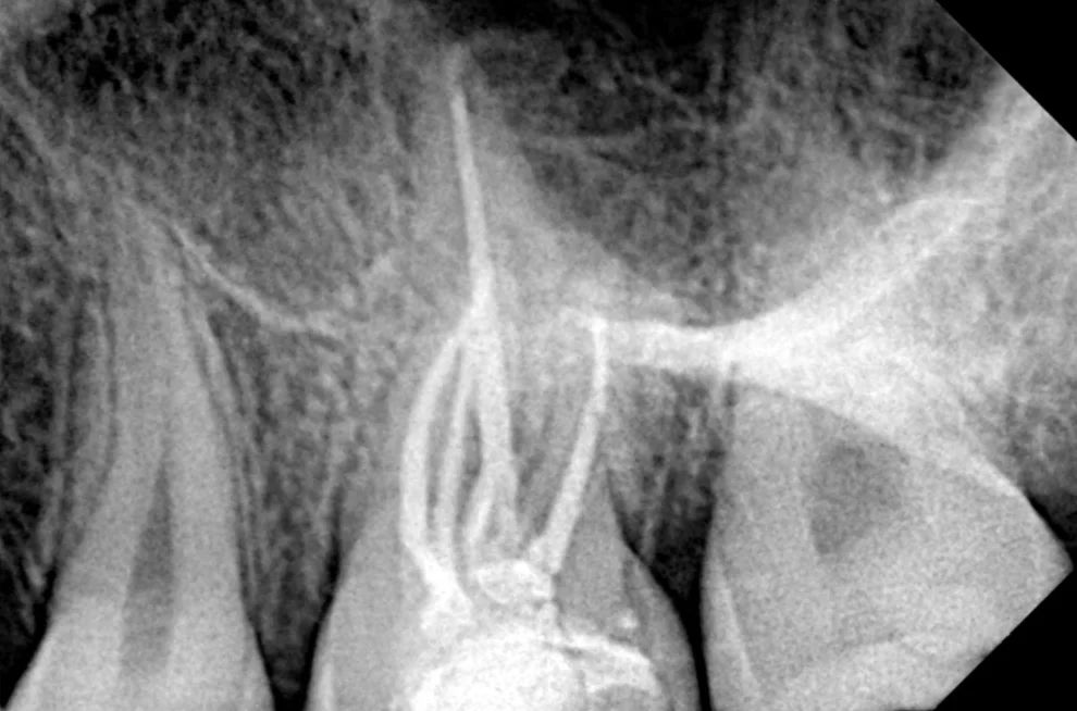 Radiografía final del molar con los conductos de las raíces obturados hasta el extremo de cada raíz