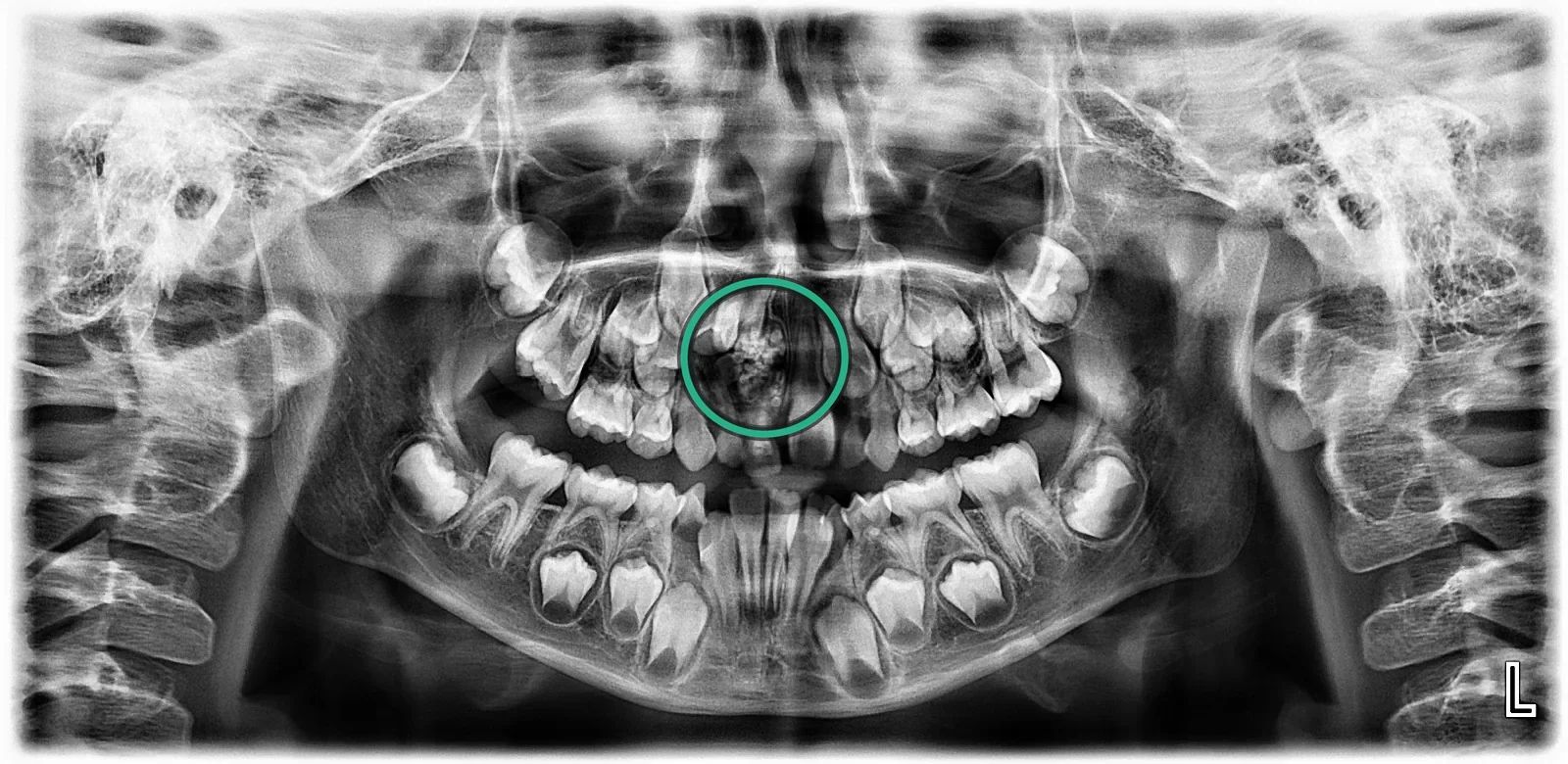 Radiografía panorámica de una dentición mixta con una masa radiopaca, señalada con un círculo, entre los dientes anteriores superiores
