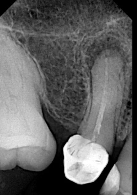 Radiografía de un primer premolar superior con un tratamiento de conductos previo, corona en mal estado y lesión en el extremo de la raíz
