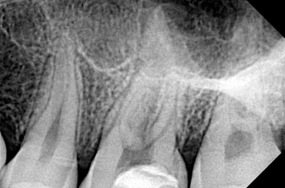 Radiografía periapical de un molar superior con la cámara pulpar abierta, antes del tratamiento de conductos