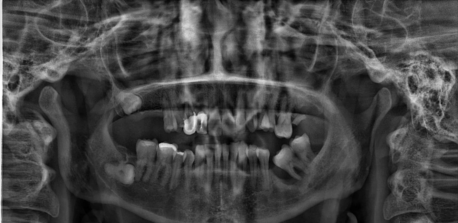 Radiografía panorámica con el tercer molar inferior derecho retenido en profundidad dentro del hueso, junto al segundo molar