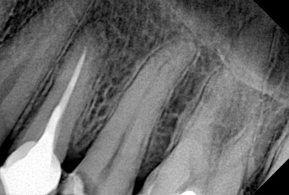 Radiografía periapical del segundo premolar superior con una caries profunda y material provisorio en la corona, antes del tratamiento