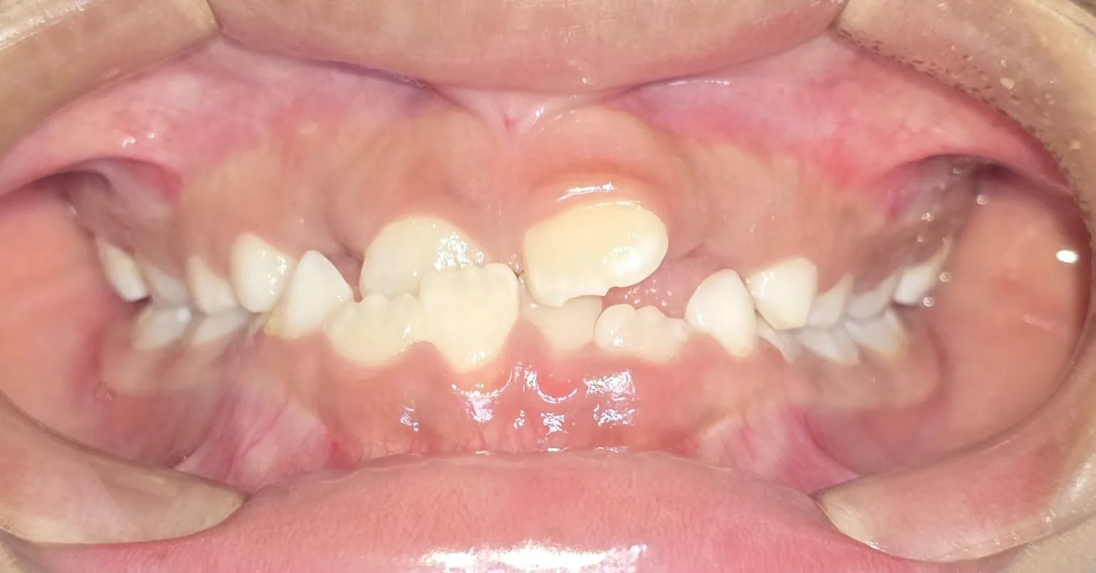 Vista frontal de una dentición mixta, con un incisivo central superior por detrás de los inferiores