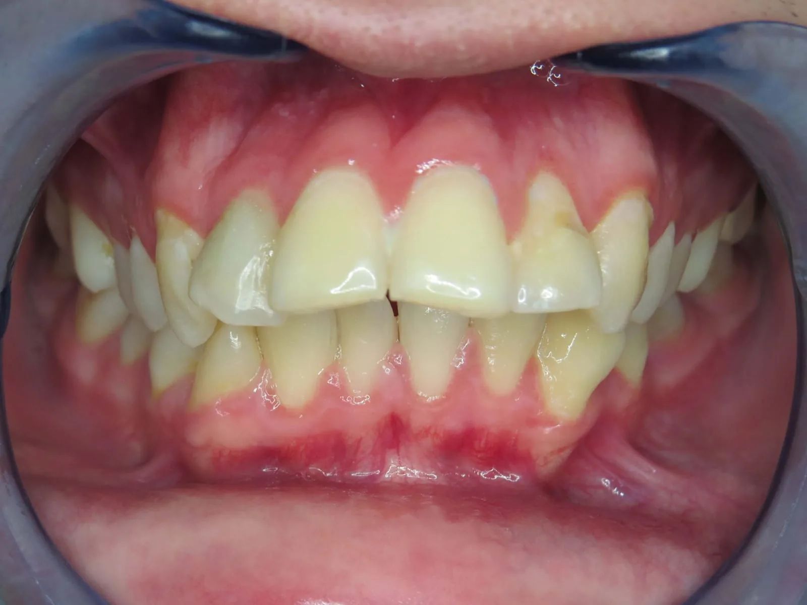 Vista frontal en mordida al inicio, con los incisivos superiores adelantados y los dientes apiñados