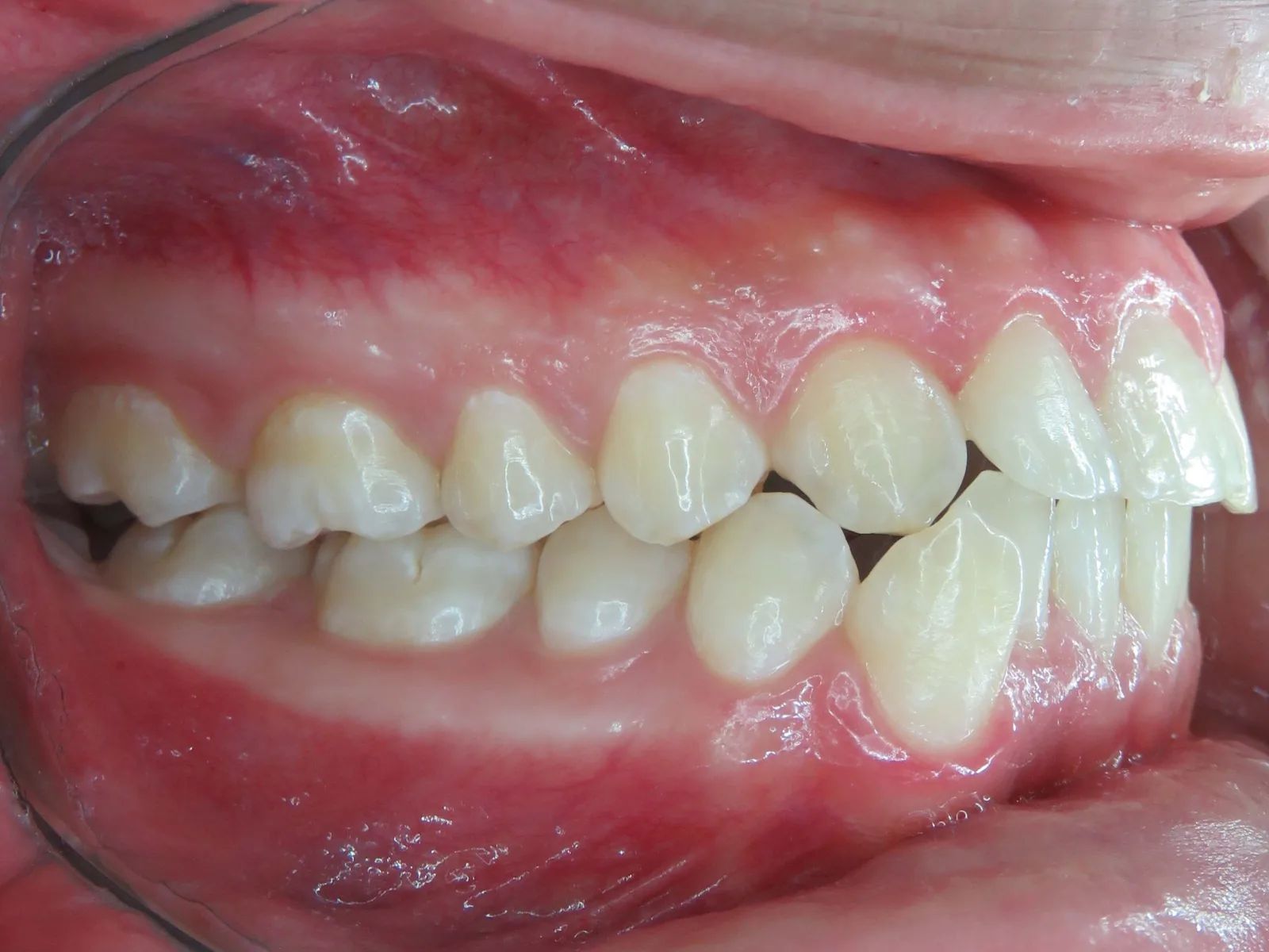 Vista lateral derecha al inicio, con los dientes superiores e inferiores sin encajar