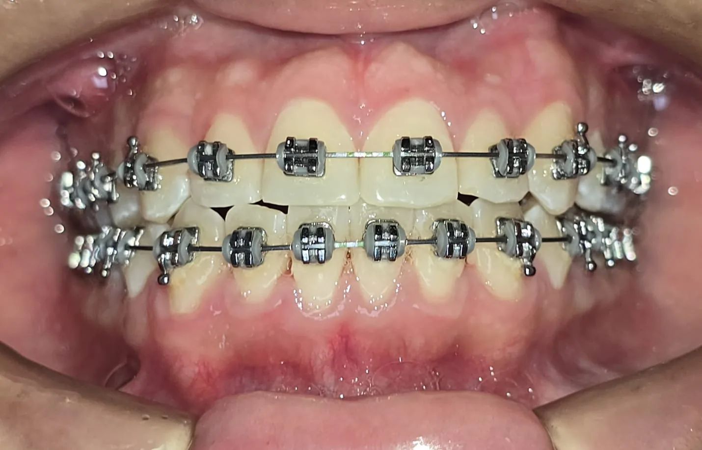 Vista frontal a los 10 meses, con brackets en ambas arcadas y las líneas medias más cerca una de otra