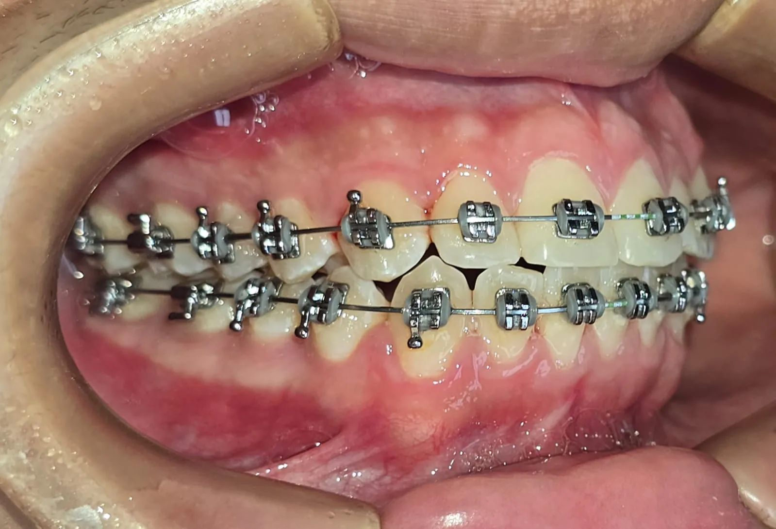 Vista lateral derecha a los 10 meses, con brackets y los dientes en proceso de alineación
