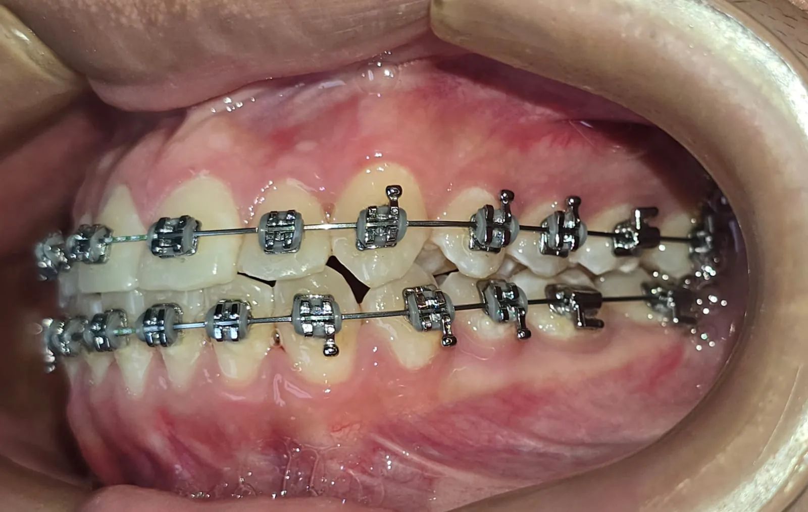 Vista lateral izquierda a los 10 meses, con brackets y el canino incorporado a la arcada