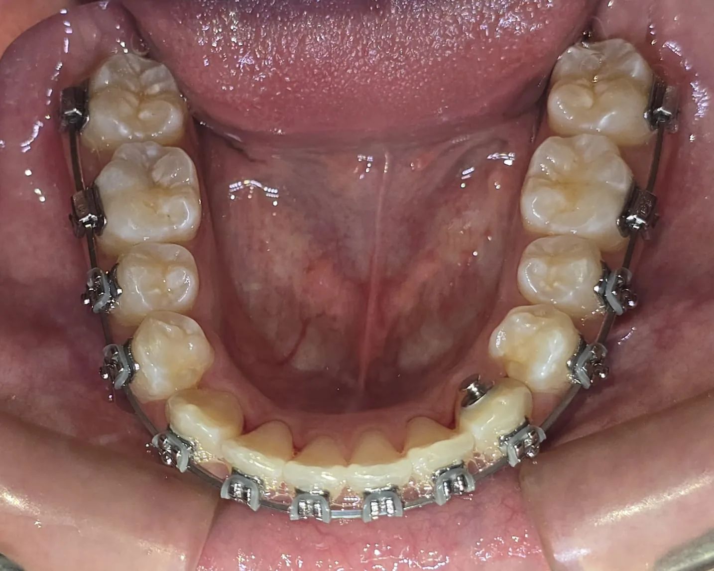 Arcada inferior vista desde arriba a los 10 meses, con brackets y los incisivos alineados