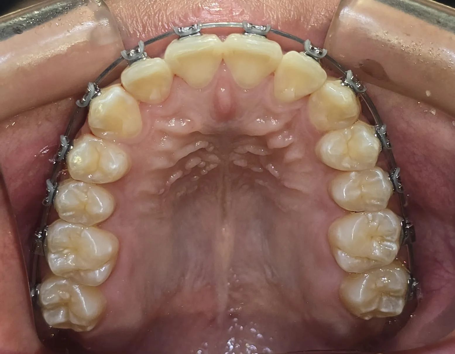 Arcada superior vista desde abajo a los 10 meses, con brackets y los dientes formando una curva continua