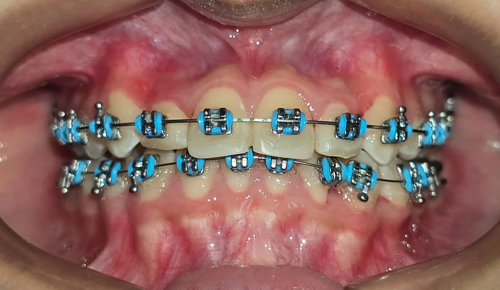 Vista frontal a los 12 meses, con brackets en ambas arcadas y los caninos integrados a la arcada