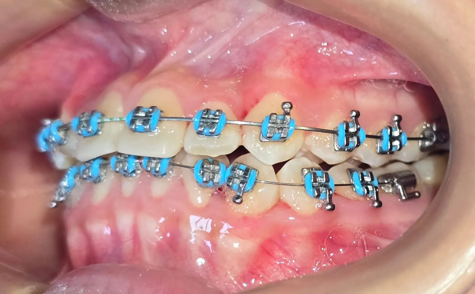 Vista lateral izquierda a los 12 meses, con brackets y los dientes superiores por delante de los inferiores