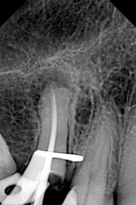 Radiografía del mismo premolar sin la corona, aislado con grapa y con una lima dentro del conducto durante el retratamiento